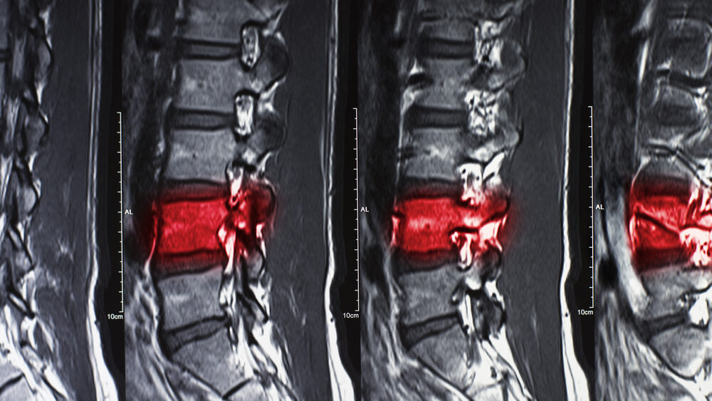 Florida Spinal Cord Injury Lawyers